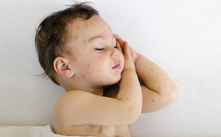 bed-bug-bites-on-babies-pictures-photos