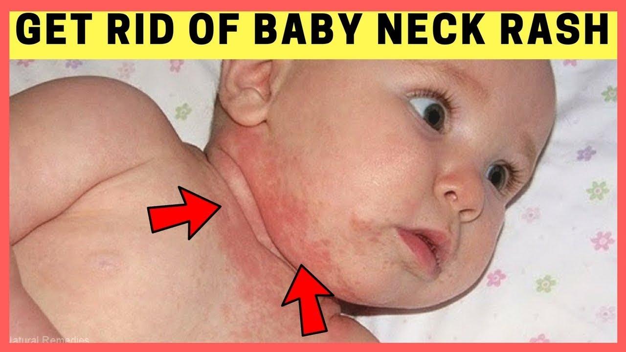 Bumps On Baby Neck And Chest