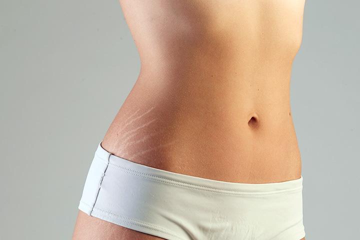 Stretch Marks: Learn About Causes and Treatment