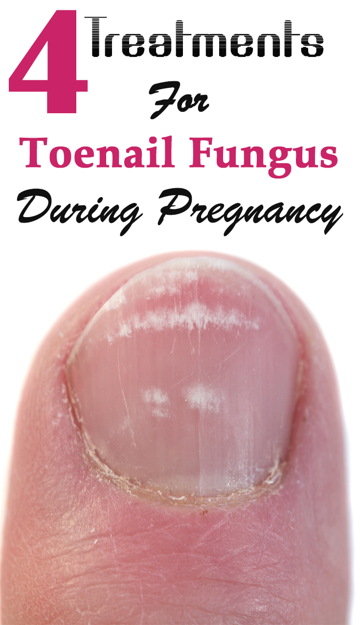 What are some good treatments for white toe nail fungus?