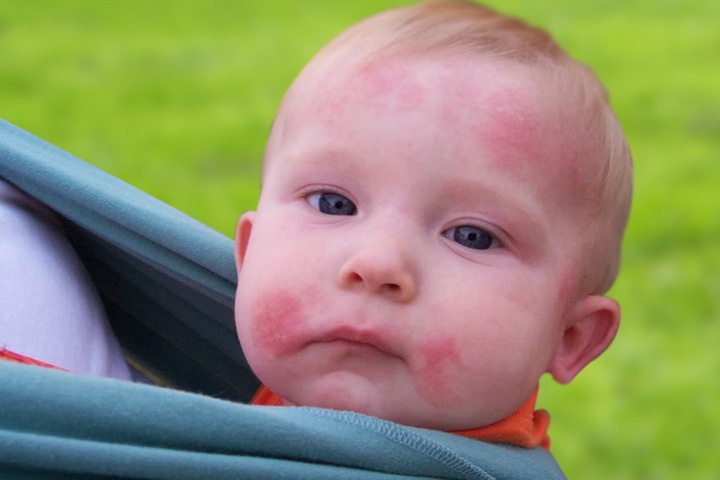 babies with ringworm