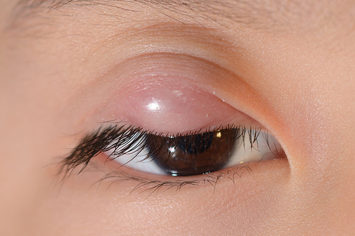 What are the treatment options for a sty in the eye?