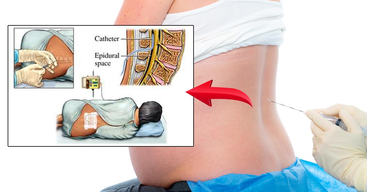 epidural for labor why is it done and what are its side effects how an epidural works