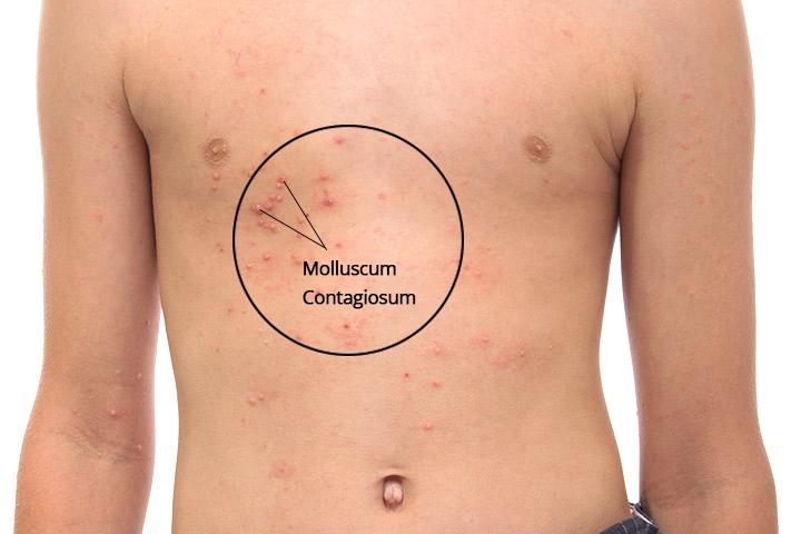 Molluscum Contagiosum In Children