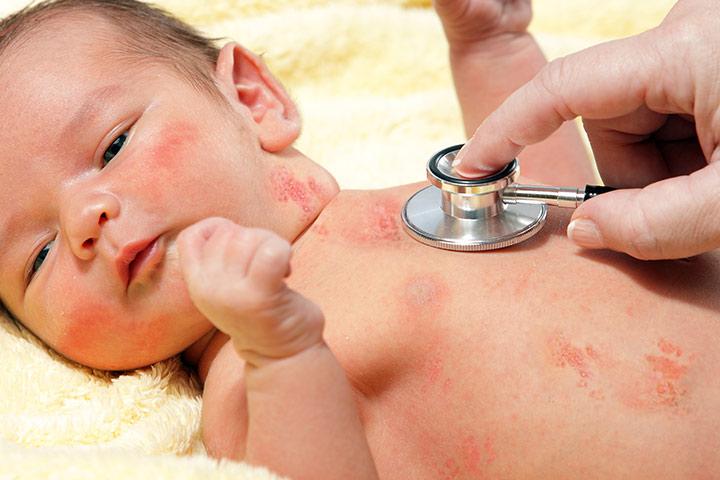 Chickenpox - close-up: MedlinePlus Medical Encyclopedia Image