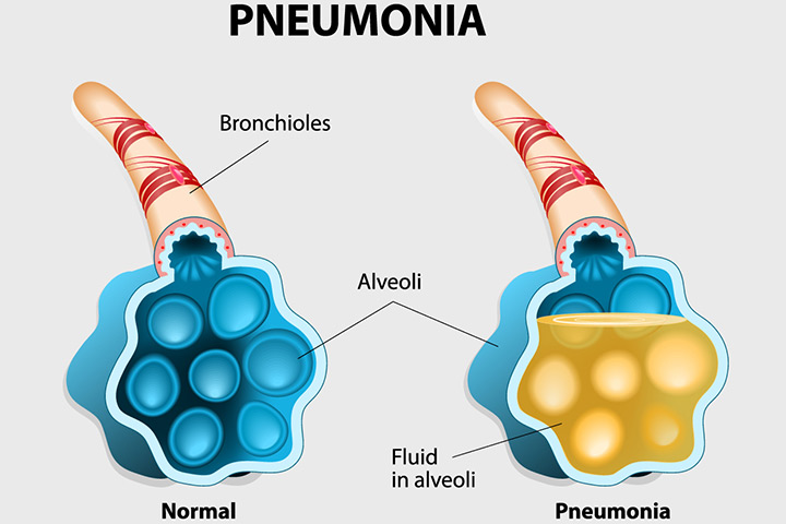 Image result for Pneumonia