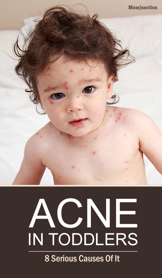 acne-in-toddlers-check-out-books-app-how-to-cure-pimples-on-the-face