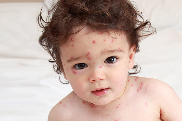 Image result for images of toddlers with acne