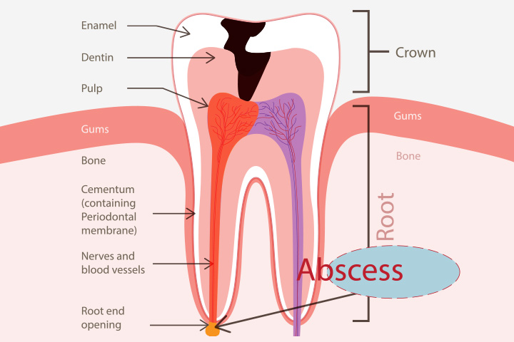 What are the different types of dental abscesses?