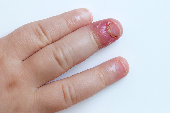 What Causes a Finger Infection ? - eMedicineHealth