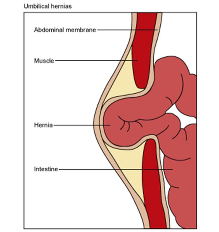 Umbilical Hernia Presentation