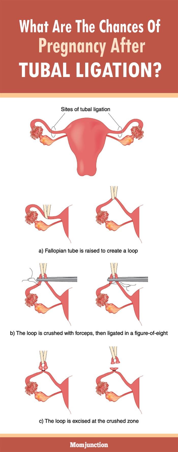 what-are-the-chances-of-pregnancy-after-tubal-ligation