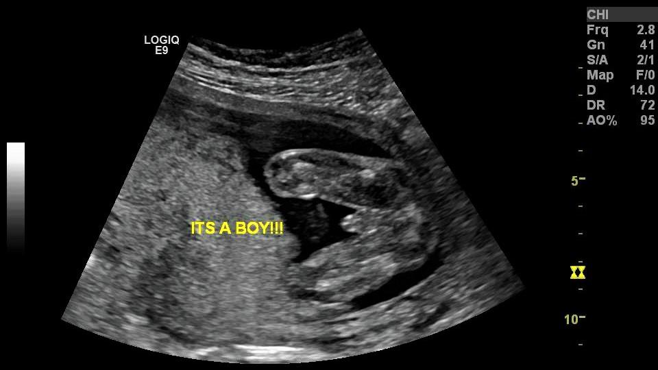 Most accurate time for dating ultrasound
