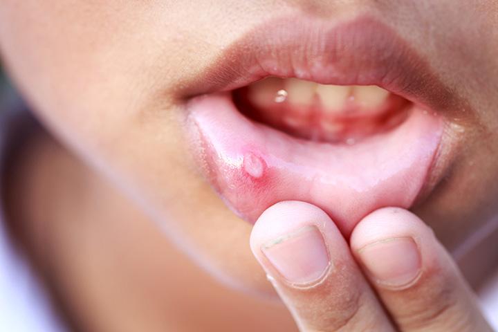 How long does it take fever blisters to go away?