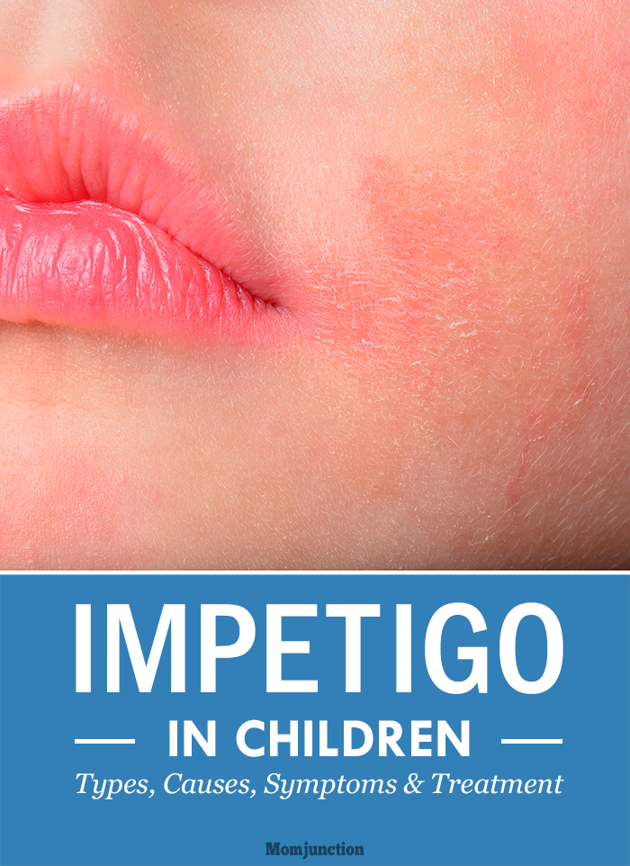Impetigo: Diagnosis and Treatment - American Family Physician