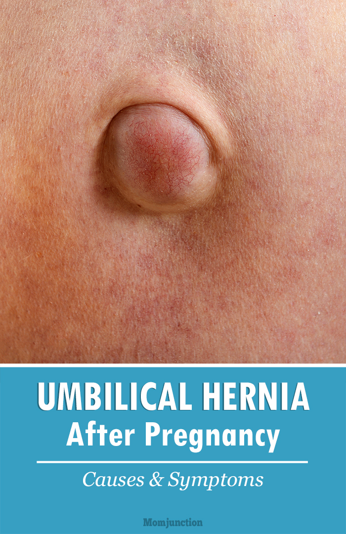 Adult Umbilical Hernia Pictures 106