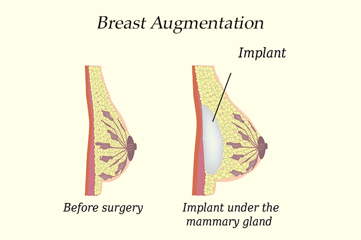 Teen Breast Augmentation Photos 68