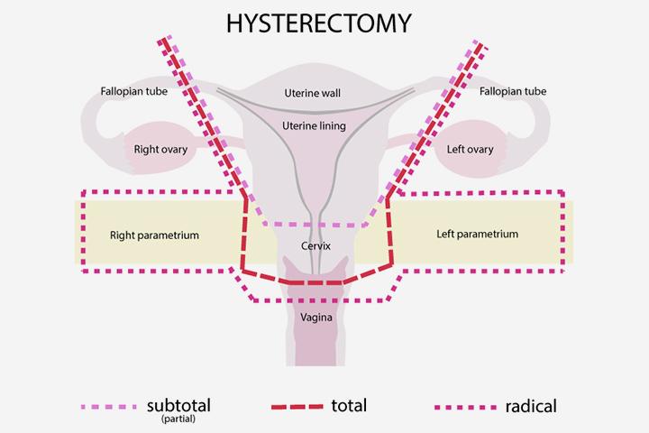 Birth Control Weight Loss Or Gain After Hysterectomy Photos By Kim