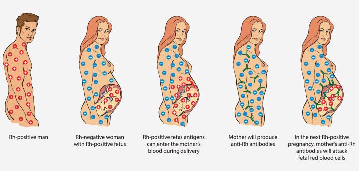 Rh Mismatch What Does It Mean To You And Your Baby Rh Mismatch What Does It Mean To You And Your Baby