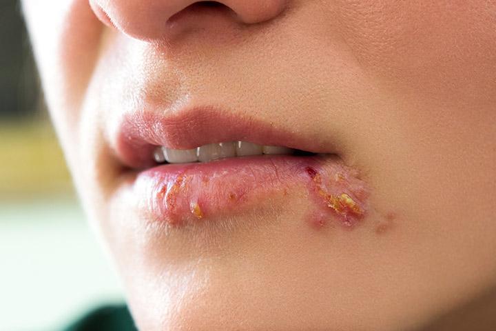 Is A Cold Sore Dangerous For The Growing Fetus Is A Cold Sore Dangerous For The Growing Fetus