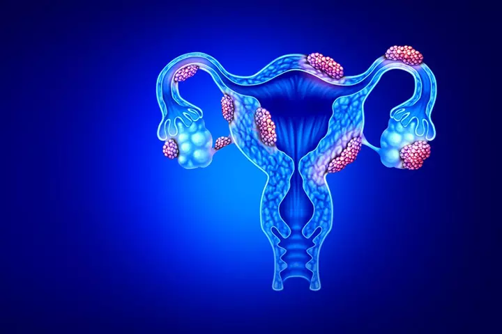 Endometriosis can create an unhealthy environment around the egg