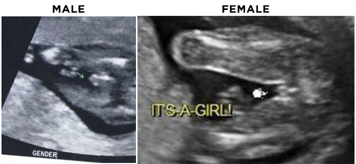 Can ultrasound be wrong about gender at 25 weeks.