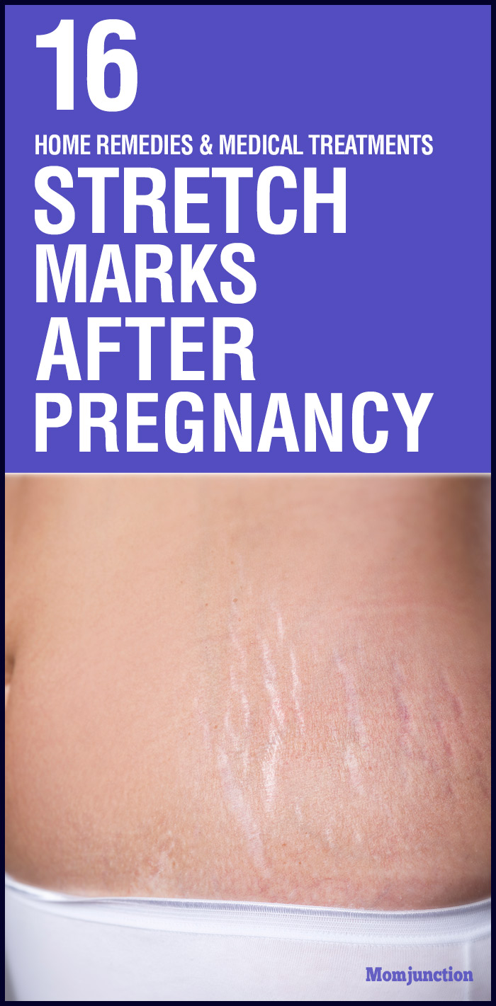 How To Remove Stretch Marks After Pregnancy: 16 Home Remedies