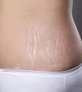 How To Remove Stretch Marks After Pregnancy: 16 Home Remedies & Medical Treatments