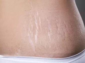 How-To-Remove-Stretch-Marks-After-Pregnancy-16-Home-Remedies-Medical-Treatments