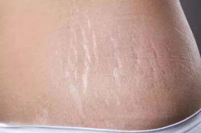 How To Remove Stretch Marks After Pregnancy: 16 Home Remedies & Medical Treatments