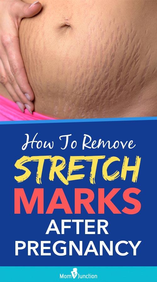 How To Remove Stretch Marks After Pregnancy 16 Home Remedies