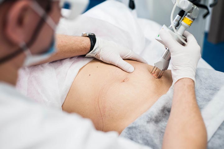 Laser therapy helps remove stretch marks after pregnancy