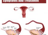 PCOS And Pregnancy - Causes, Symptoms And Treatment
