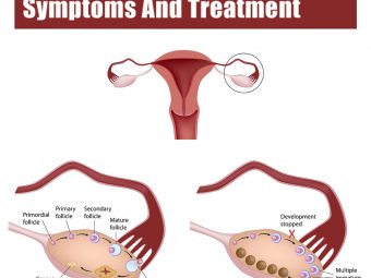 PCOS And Pregnancy: Causes, Symptoms And Treatment