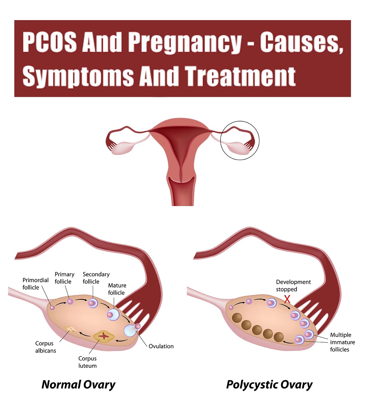 PCOS And Pregnancy: Causes, Symptoms And Treatment