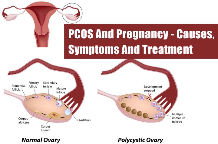 pcos bleeding between periods