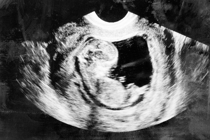 Ultrasound scan at 10th week pregnancy