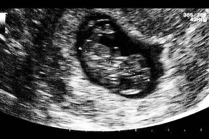 Ultrasound scan in 7th week of pregnancy