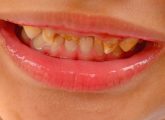 Bruxism In Kids – Causes, Symptoms And Treatment