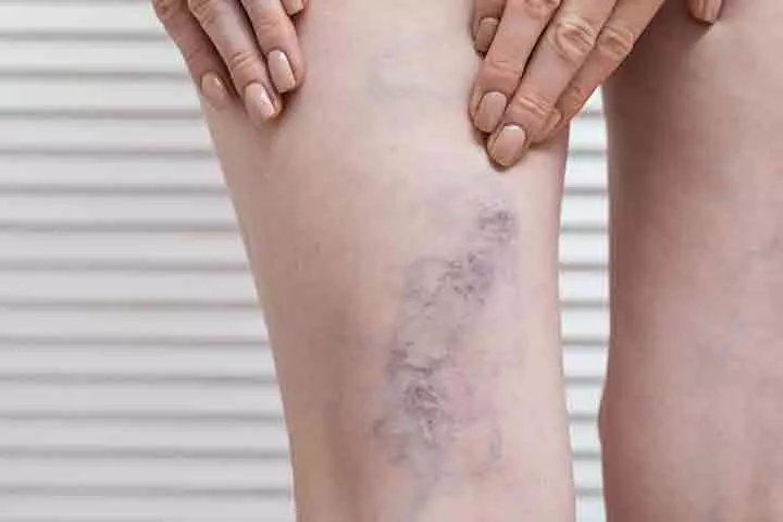 The excess blood flow to the lower body may cause varicose vein.