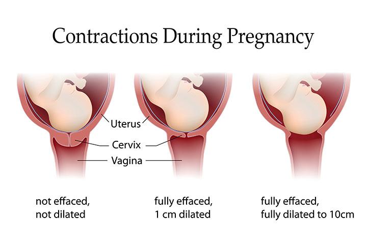 Labor Contractions Chart