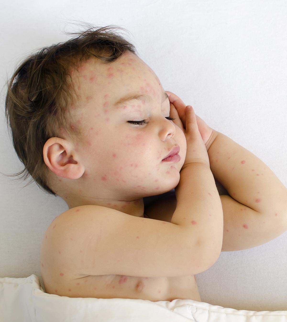 5 Safe And Effective Treatments For Bug Bites in Babies
