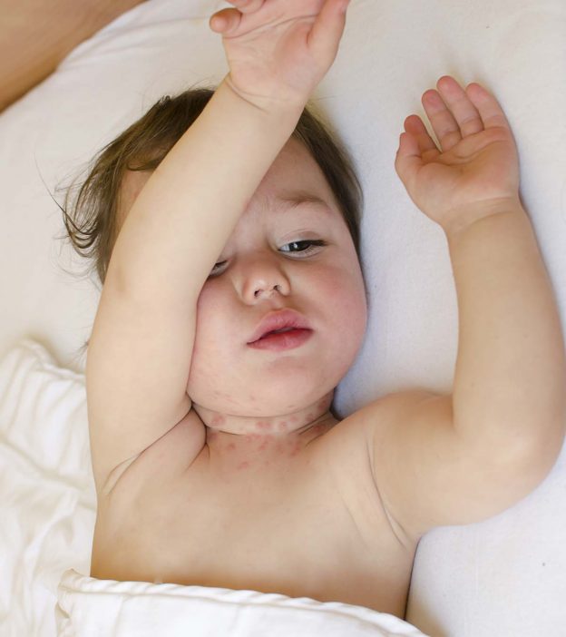 Baby Neck Rash: Causes, Symptoms And Treatment