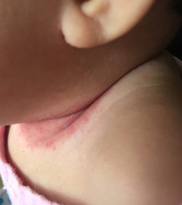Baby Neck Rash: Causes, Symptoms And Treatment