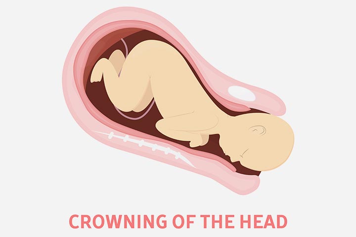 Baby crowning is the appearance of baby's head through vagina