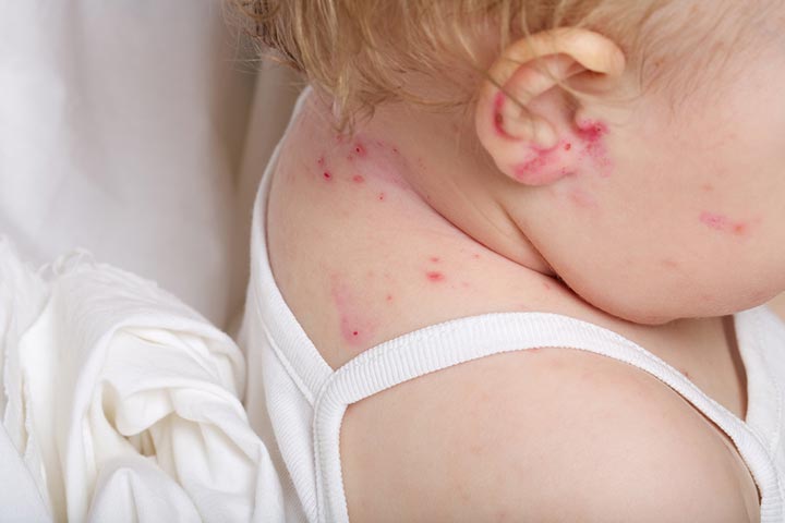 Bug bites may cause swollen bumps