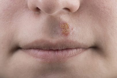 Canker Sores In Children -  Causes, Treatment And Remedies