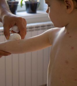 Symptoms Of Smallpox In Children And Its Treatment