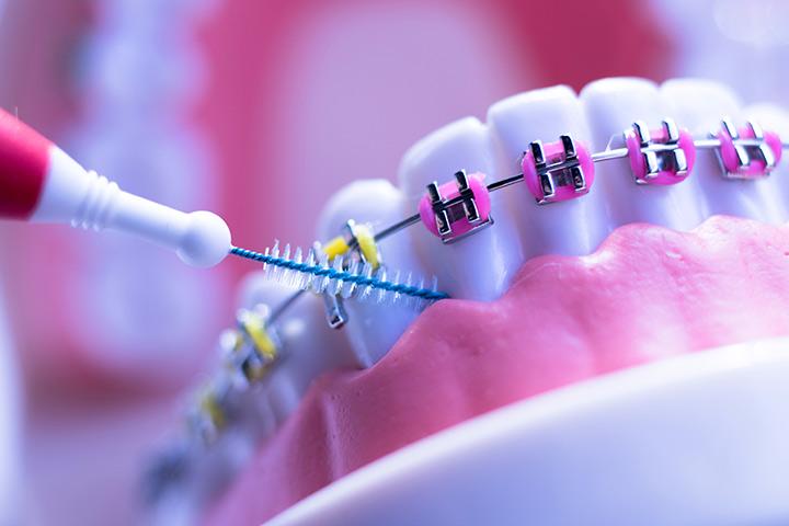 Braces For Kids: Right Age To Get Them And Dental Care To Take