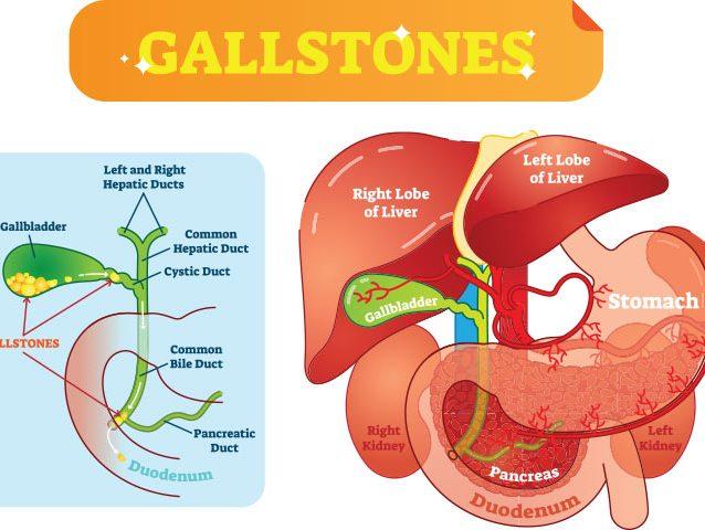 gallbladder-pain-in-pregnancy-causes-symptoms-treatment